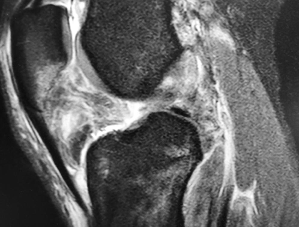 Fig. 11.2, Sagittal knee T2 weighted magnetic resonance imaging showing anterior and posterior cruciate ligament tears.