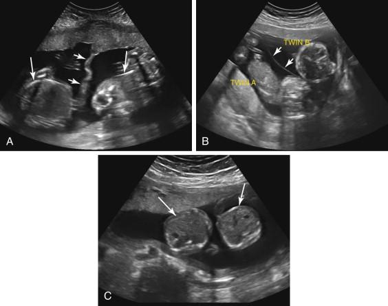 F igure 21-1, Types of twinning. A, Dichorionic diamniotic twinning. Axial view of the gravid uterus during the second trimester shows two gestational sacs, each containing a fetus (long arrows) . The gestational sacs are separated by a thick membrane (short arrows) consisting of four layers, a layer of amnion and a layer of chorion from each of the two fetuses. B, Monochorionic diamniotic twinning. Longitudinal image of the gravid uterus during the second trimester shows two gestational sacs, each containing a fetus (Twin A and Twin B). The gestational sacs are separated by a thin membrane (short arrows) consisting of two layers, a layer of amnion from each fetus. C, Monochorionic monoamniotic twinning. Longitudinal image of the gravid uterus during the second trimester shows a single gestational sac with two fetuses (arrows). No intertwin membrane is seen.