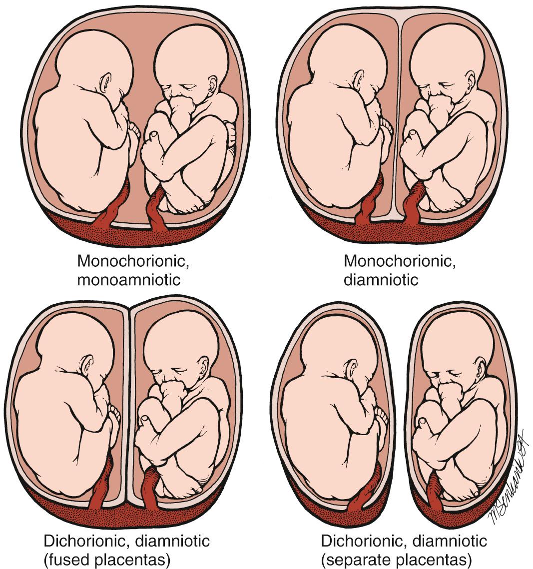 Fig. 39.1, Placentation in Twin Pregnancies.