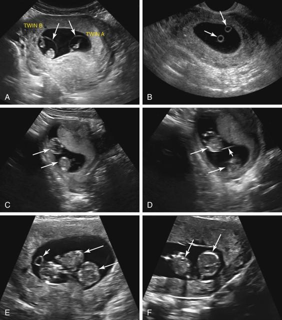 F igure 21-2, Diamniotic twinning versus monoamniotic twinning. A to D, Monochorionic diamniotic twinning. A, Two gestational sacs. Axial image of the gravid uterus shows two discrete gestational sacs (arrows) confirming diamniotic twinning. B, Two yolk sacs. Oblique image of the gravid uterus shows two yolk sacs (arrows) . Identification of two yolk sacs usually indicates diamniotic twinning. Other images revealed a thin intertwin membrane (not shown). C and D, Difficulty identifying the intertwin membrane in a monochorionic diamniotic pregnancy. C, Longitudinal image of the gravid uterus shows two embryos (arrows) . Although no intertwin membrane is seen on this image, it can be difficult to identify the thin intertwin membrane of a monochorionic diamniotic gestation early in pregnancy. D, Longitudinal image of the same pregnancy as in image C , obtained after adjustment of scan plane to assess for a membrane, shows a thin intertwin membrane (short arrow) . Two embryos are again seen (long arrows) . E and F, Monochorionic monoamniotic twinning. E, Single yolk sac. Oblique image of a different pregnancy at 10 weeks gestation shows two embryos (long arrows) and a single yolk sac (short arrow) with no evidence of an intertwin membrane, consistent with monochorionic monoamniotic twinning. F, Oblique image of the same pregnancy as in image E , obtained 3 weeks later again shows twins (long arrows) with no evidence of an intertwin membrane, confirming monochorionic monoamniotic twinning.