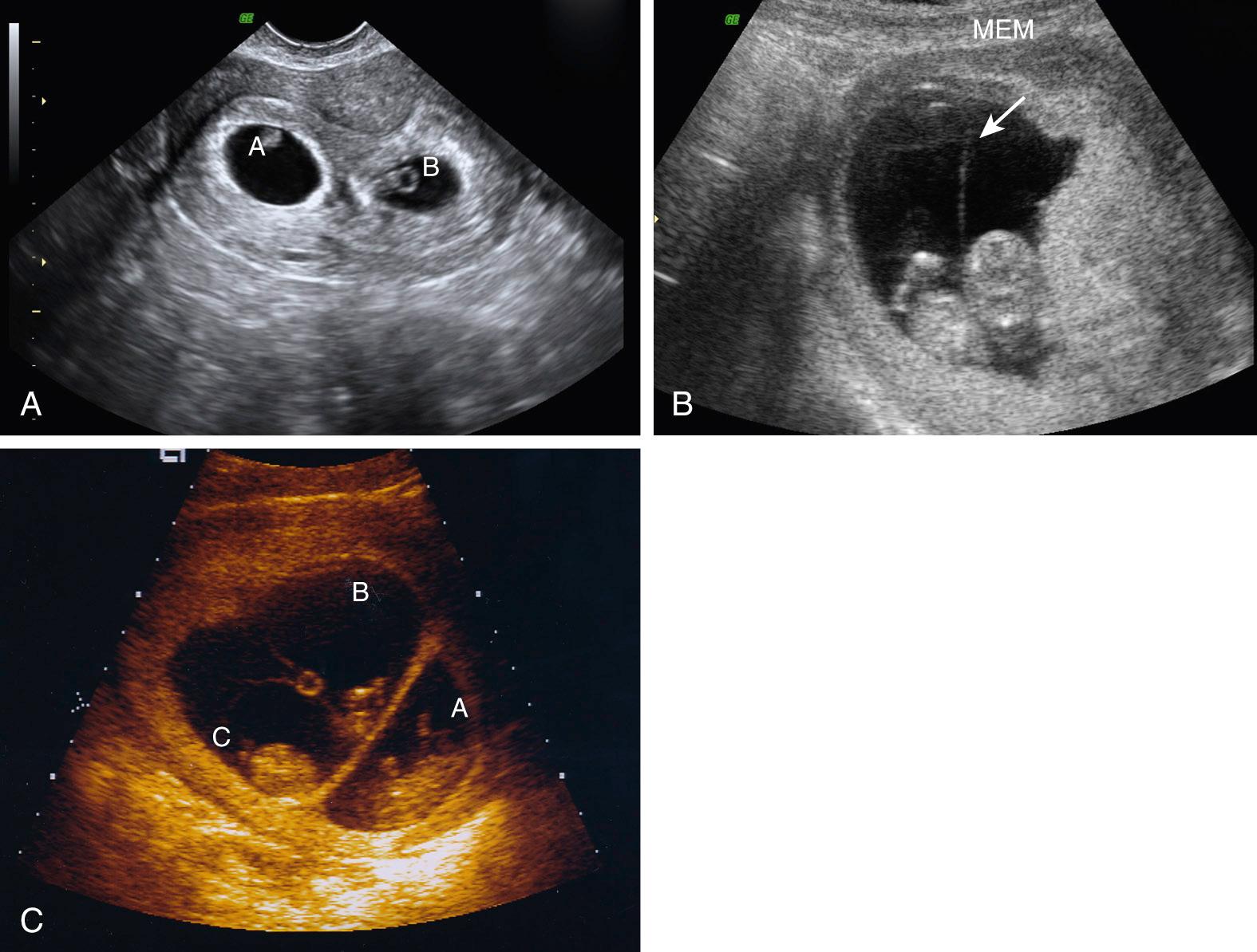 Fig. 39.2, (A) Early first-trimester dichorionic twin gestation. Note the clearly separate gestational sacs, each surrounded by a thick echogenic ring. (B) Mid–first-trimester monochorionic diamniotic twin pregnancy with a thin, hair-like dividing membrane (MEM, arrow) . (C) Early first-trimester image of a dichorionic triamniotic triplet pregnancy. Note that monochorionic triplets B and C are separated by a thin membrane, whereas triplet A —with its own placenta—is separated from B and C by a thick membrane.