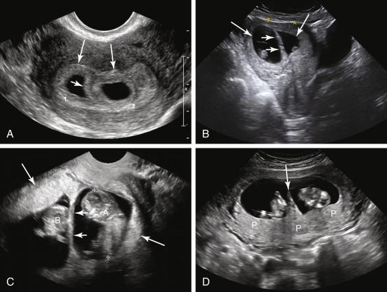 F igure 21-3, Dichorionic diamniotic twinning. A and B, Thick dividing septum. Transverse images of two different twin pregnancies during the first trimester show two gestational sacs (long arrows) separated by a thick dividing septum (short arrows) . C, Two placentas. Oblique image of a twin pregnancy at 11 weeks gestation depicts two discrete placental sites (long arrows) confirming dichorionic diamniotic twinning. A thick dividing septum (short arrows) is also seen. D, Twin peak sign. Axial image of a twin pregnancy at 11 weeks demonstrates a triangular projection of placental tissue (arrow) extending into the base of the intertwin membrane, confirming dichorionic diamniotic twinning, even though two discrete placental sites are not seen. P, Placenta.