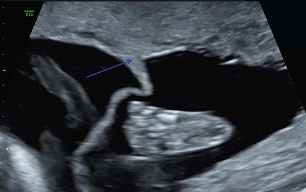 Fig. 39.3, Twin Peak Sign (Arrow) in a Dichorionic Twin Pregnancy.