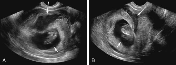 F igure 21-4, Subchorionic hematoma resembling a second gestational sac. A, Oblique image of the gravid uterus during the first trimester shows an intrauterine gestational sac (short arrow) with an embryo (E). A complicated fluid collection with internal echoes (long arrow) adjacent to the gestational sac suggests the presence of a second gestational sac. B, Image of the same pregnancy as in A in a different scan plane confirms the fluid collection (long arrow) is adjacent to the gestational sac (short arrow) , and reveals it has a crescentic configuration favoring a subchorionic hematoma instead of a second gestational sac.