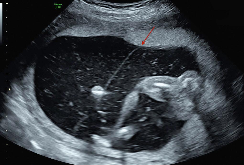 Fig. 39.4, T-Sign (Arrow) in a Monochorionic Twin Pregnancy.