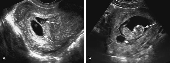 F igure 21-5, Vanishing twin. A, Oblique image of the gravid uterus at 6 weeks shows two gestational sacs (arrows) consistent with a twin pregnancy. An embryo with cardiac activity was seen in each gestational sac. B, Ultrasound performed 6 weeks after the image in A due to vaginal bleeding shows appropriate growth of one twin (long arrow) that exhibited cardiac activity at real-time evaluation, but nonvisualization of the previously seen second embryo. A small, rounded fluid collection (short arrow) adjacent to the gestational sac of the live twin corresponds to residua of the second gestational sac.
