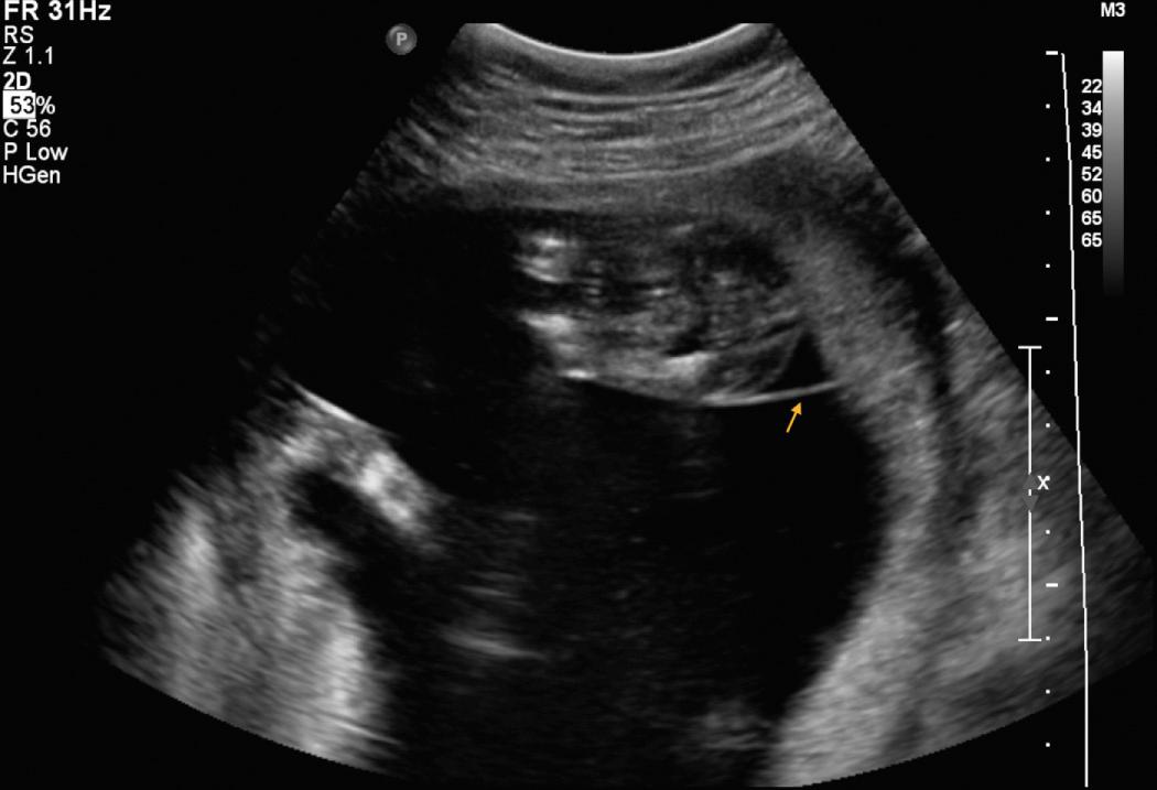 Fig. 39.6, Donor Twin “Stuck” Against the Anterior Uterine Wall in a Case of Twin-Twin Transfusion Syndrome.