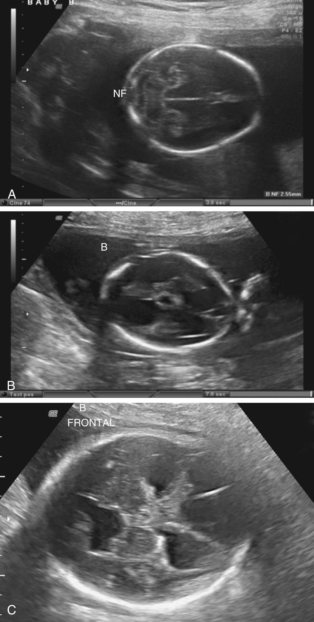 Fig. 39.7, Ultrasound of the fetal brain of a monochorionic twin before (A) and after (B and C) intrauterine fetal death of the co-twin at 20 weeks of gestation. Note the normal brain anatomy in A, the dilation and cystic changes shortly after the co-twin's death in B, and the residual irregular hydrocephalus and parenchymal loss 12 weeks later in C. B , Twin B; NF , nuchal fold.