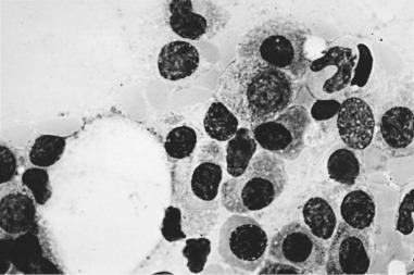 Fig. 90.1, Bone marrow diagnostic for multiple myeloma (Wright stain; original magnification × 1000).