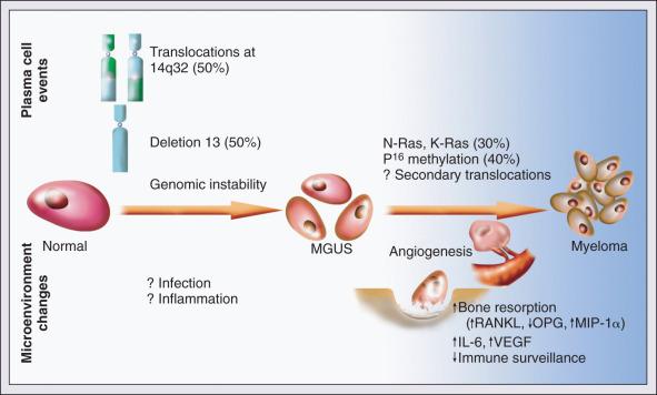 Figure 101.1, Pathogenesis of myeloma. IL-6, Interleukin-6; MGUS, monoclonal gammopathy of undetermined significance; MIP-1α, macrophage inflammatory protein-1α; OPG, osteoprotegerin; RANKL, receptor activator of nuclear factor–κB ligand; VEGF, vascular endothelial growth factor.