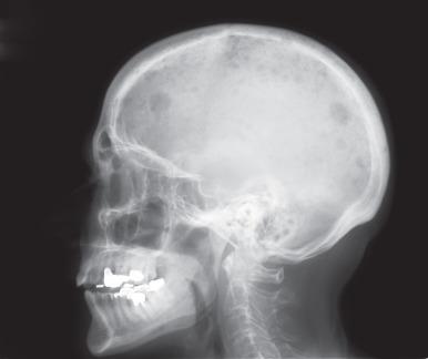 Figure 101.2, Osteolytic lesions in the skull on plain radiograph in a patient with myeloma.