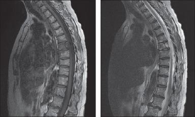 Figure 101.3, Magnetic resonance images of the spine in a patient with myeloma showing marrow edema of T11 and L1–L3 vertebral bodies. Marrow signal intensity is diffusely heterogeneous, consistent with patient's known clinical diagnosis of multiple myeloma.