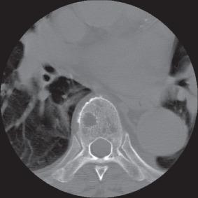 Figure 101.4, Computed tomographic scan of a vertebral body showing osteolytic bone lesions in a patient with myeloma.