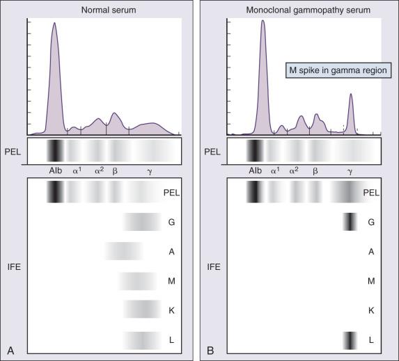 Figure 101.5, (A) Serum protein electrophoresis (PEL) and immunofixation (IFE) showing a normal pattern with no evidence of monoclonal protein. (B) Serum PEL showing a monoclonal (M) protein in the gamma region, which is IgG lambda on immunofixation (IFE).