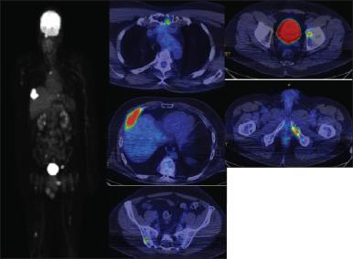 Figure 101.6, Fluorodeoxyglucose–positron emission tomography (FDG-PET) images of bone lesions in a patient with myeloma showing lesions in the sternum, right rib, right ilium, left hip, and left ischium.