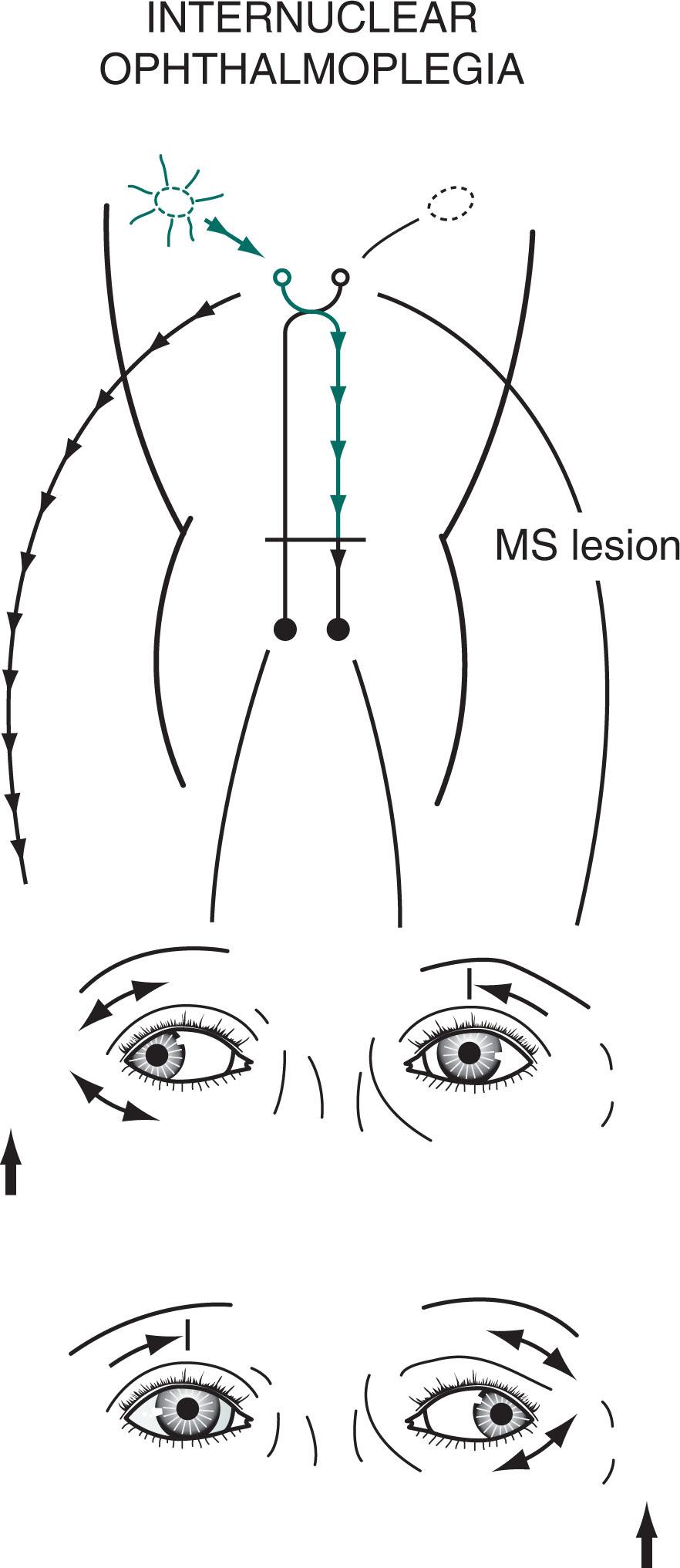 Fig. 15.4, In internuclear ophthalmoplegia (INO) , also known as the medial longitudinal fasciculus (MLF) syndrome , an interruption of the MLF prevents impulses from reaching the oculomotor (third) nuclei. Because those nuclei themselves remain intact, the pupils and eyelids are normal in both eyes. However, with a lesion in the left MLF, when looking to the right, because the left oculomotor nucleus is not stimulated, the left eye fails to adduct. The right eye abducts, but nystagmus develops. With bilateral INO, which is characteristic of MS, neither eye adducts and abducting eyes show nystagmus.