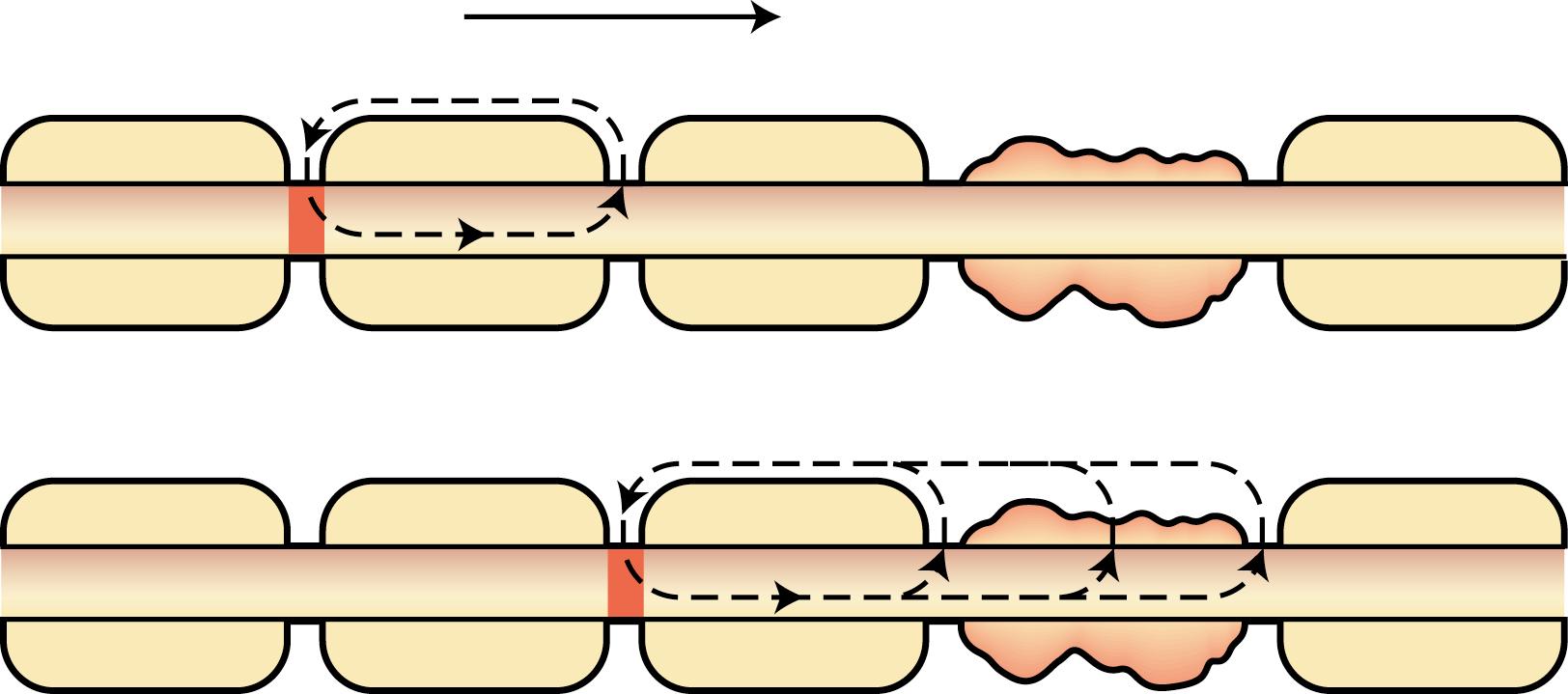 Fig. 80.1, Schematic diagram of impulse conduction in normal (upper) and demyelinated (lower) regions of a nerve fiber. Solid arrow indicates the direction of impulse conduction; red area indicates the region occupied by the impulse. Current flow is indicated by broken arrows . In normally myelinated regions (upper) , the high resistance, low capacitance directs the majority of action current to the next node of Ranvier. In contrast, in demyelinated regions (lower) , action current is short-circuited through the damaged myelin sheath or denuded regions of the axon, so further propagation of the action potential is blocked.