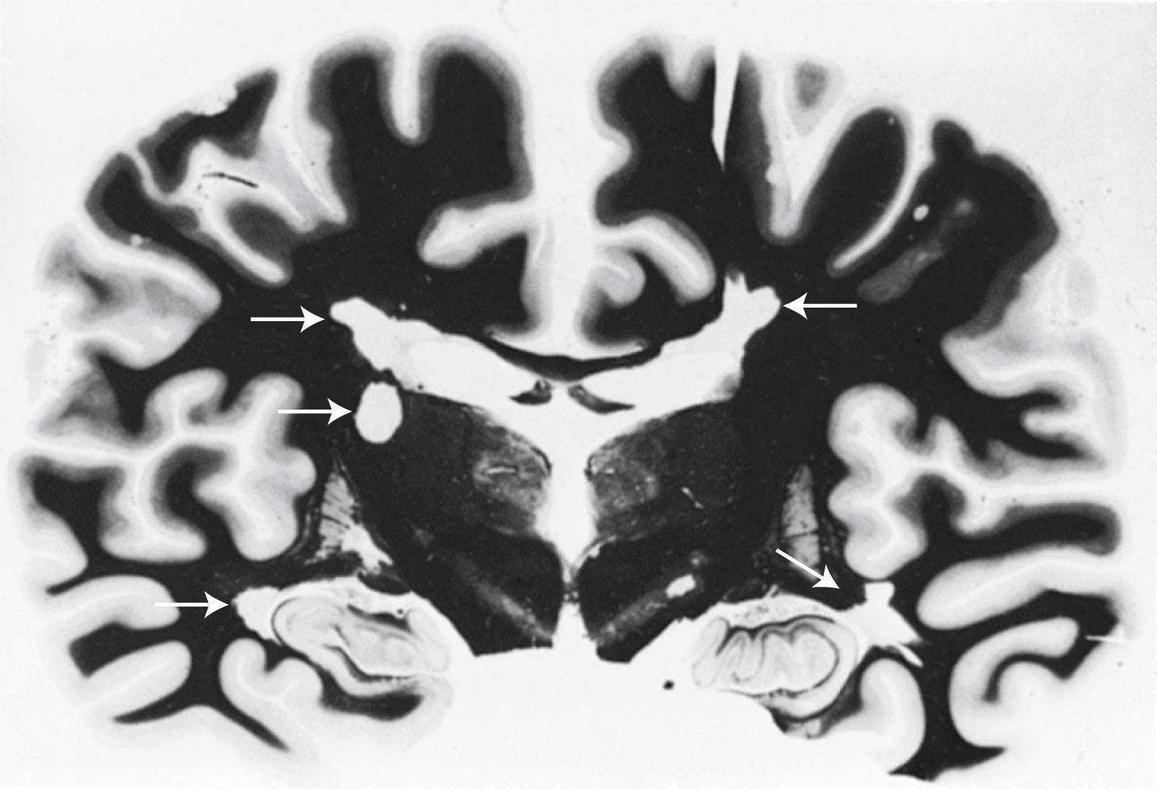 Fig. 80.2, Coronal section of brain showing large plaques adjacent to lateral ventricles and temporal horns. A plaque is also seen in the left internal capsule (arrows) (Heidenhain myelin stain).