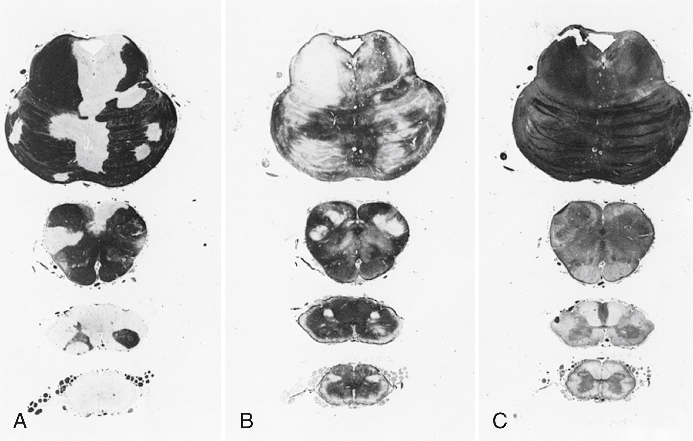 Fig. 80.3, Brainstem and spinal cord sections from patient with multiple sclerosis stained with Heidenhain myelin stain ( A ), Holzer stain for gliosis ( B ), and Bodian stain for axons ( C ). Note mirror image of myelin and Holzer stains in the pons. Also note dramatic demyelination of sacral cord with preserved myelin in nerve roots (A, bottom ).