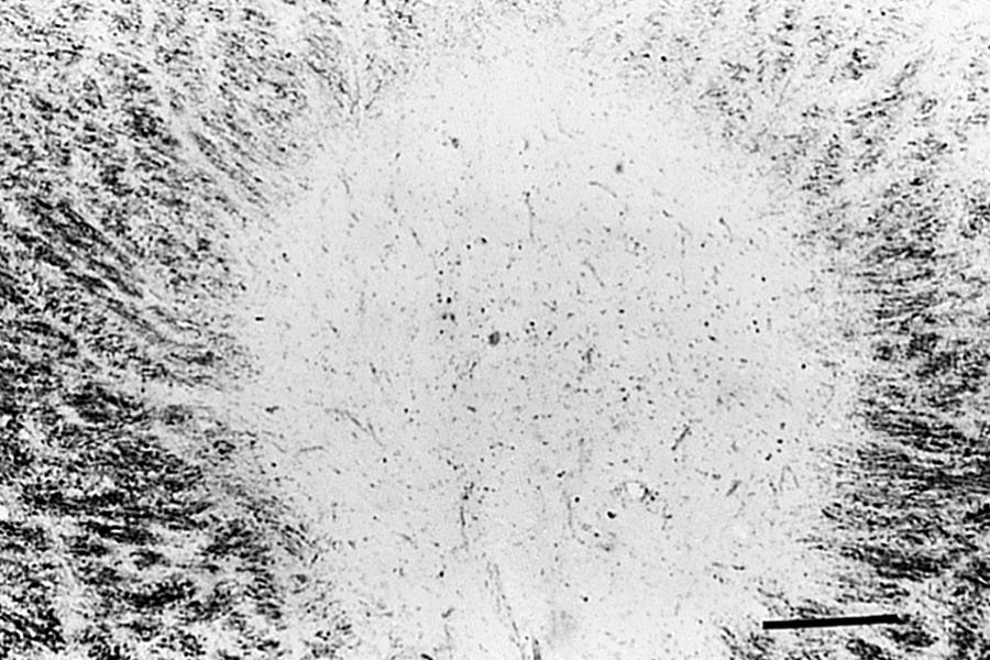 Fig. 80.4, Punched-out appearance of an old multiple sclerosis plaque surrounded by regions with varying amounts of myelin preservation (periodic acid-Schiff luxol fast blue; bar = 100 μm).