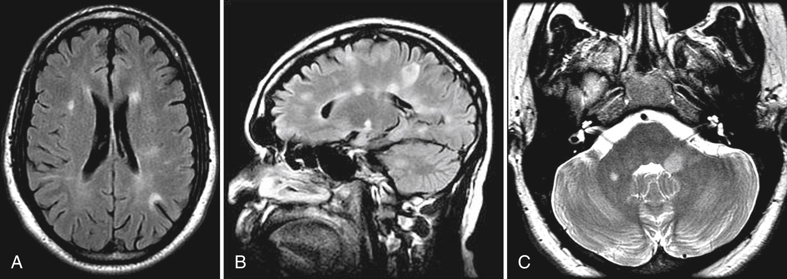 Fig. 80.8, Typical Magnetic Resonance Imaging Appearance of Multiple Sclerosis Lesions in Brain.