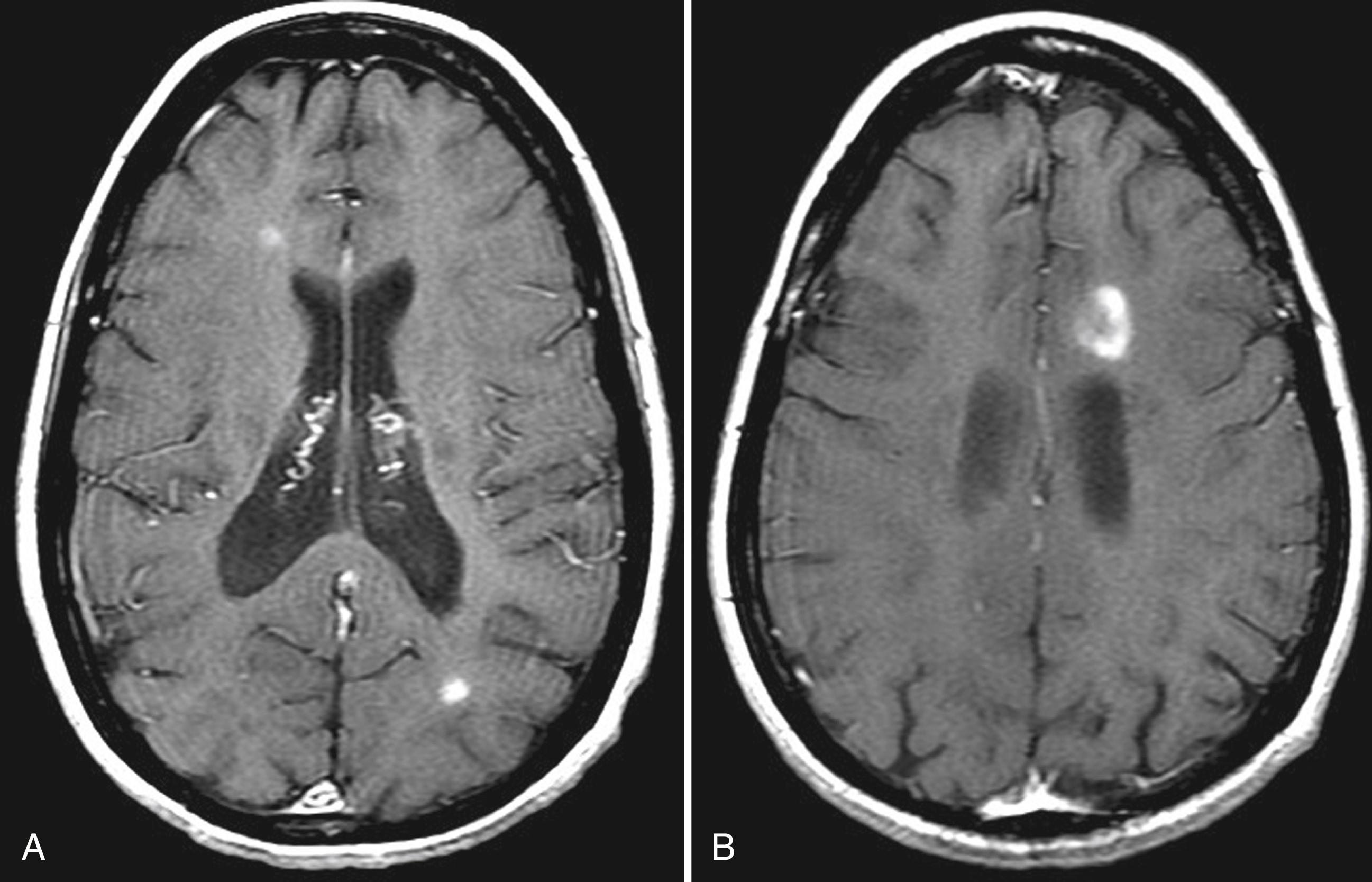 Fig. 80.9, Common Enhancement Patterns in the Brain.