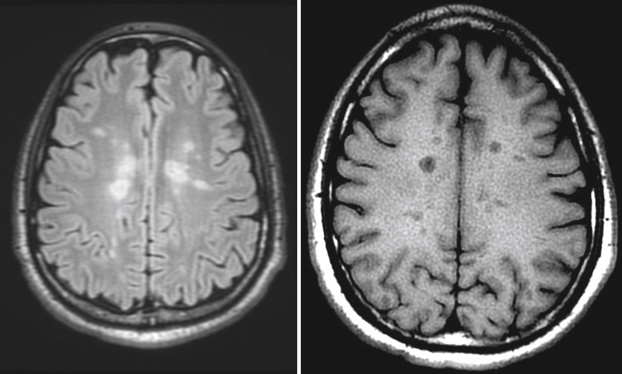 Fig. 80.10, Axial fluid-attenuated inversion recovery (FLAIR) magnetic resonance imaging with corresponding T1 image showing evidence of black holes, areas believed to represent permanent tissue destruction and atrophy.