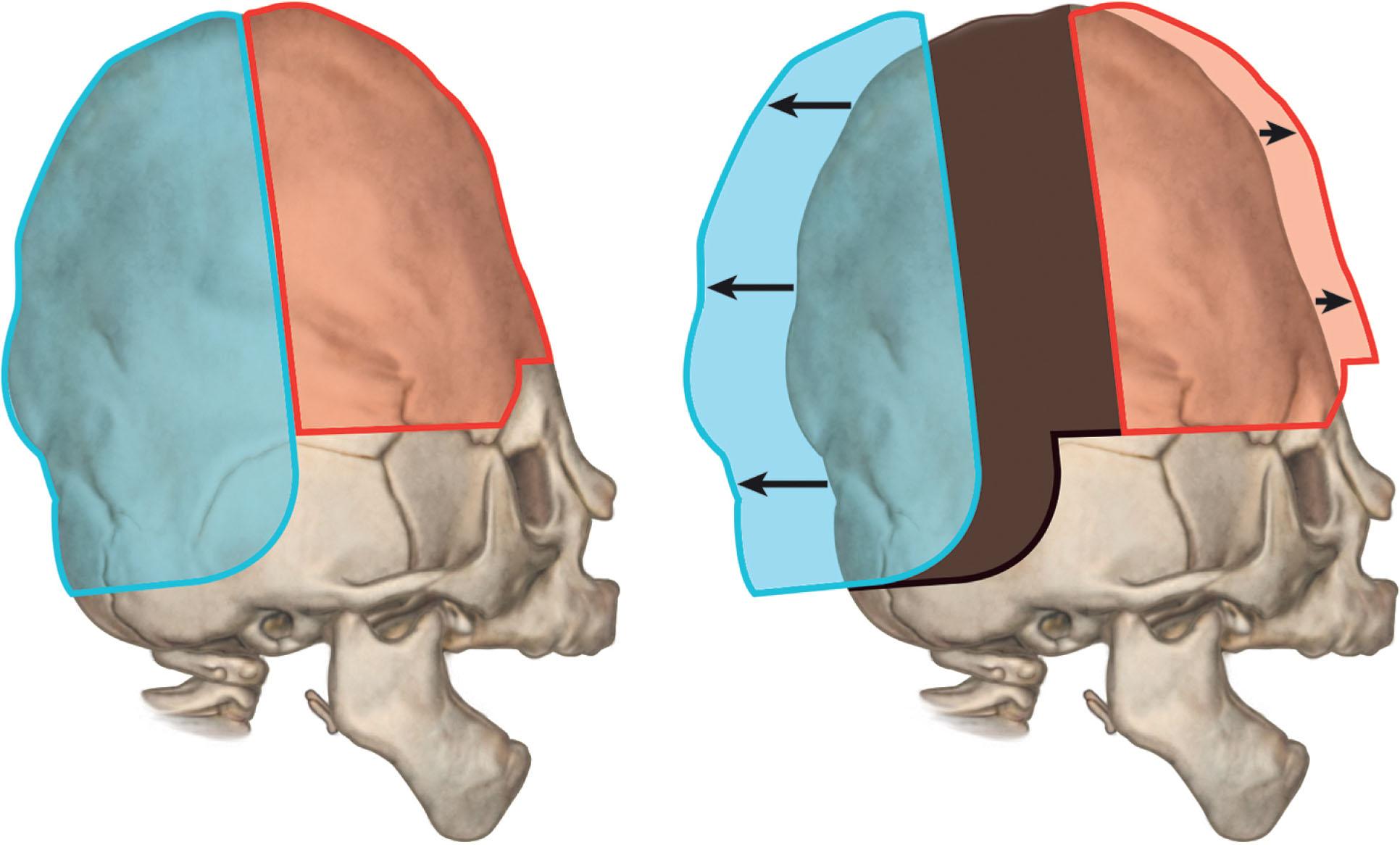 Figure 25.3.11, For syndromic patients with severe cephalocranial disproportion we prefer a posterior expansion for the first stage. This provides almost double the intracranial volume as a similar frontal expansion, and allows the definitive frontal surgery, whether fronto-orbital or monobloc, to be performed at a later age when the results are more stable.