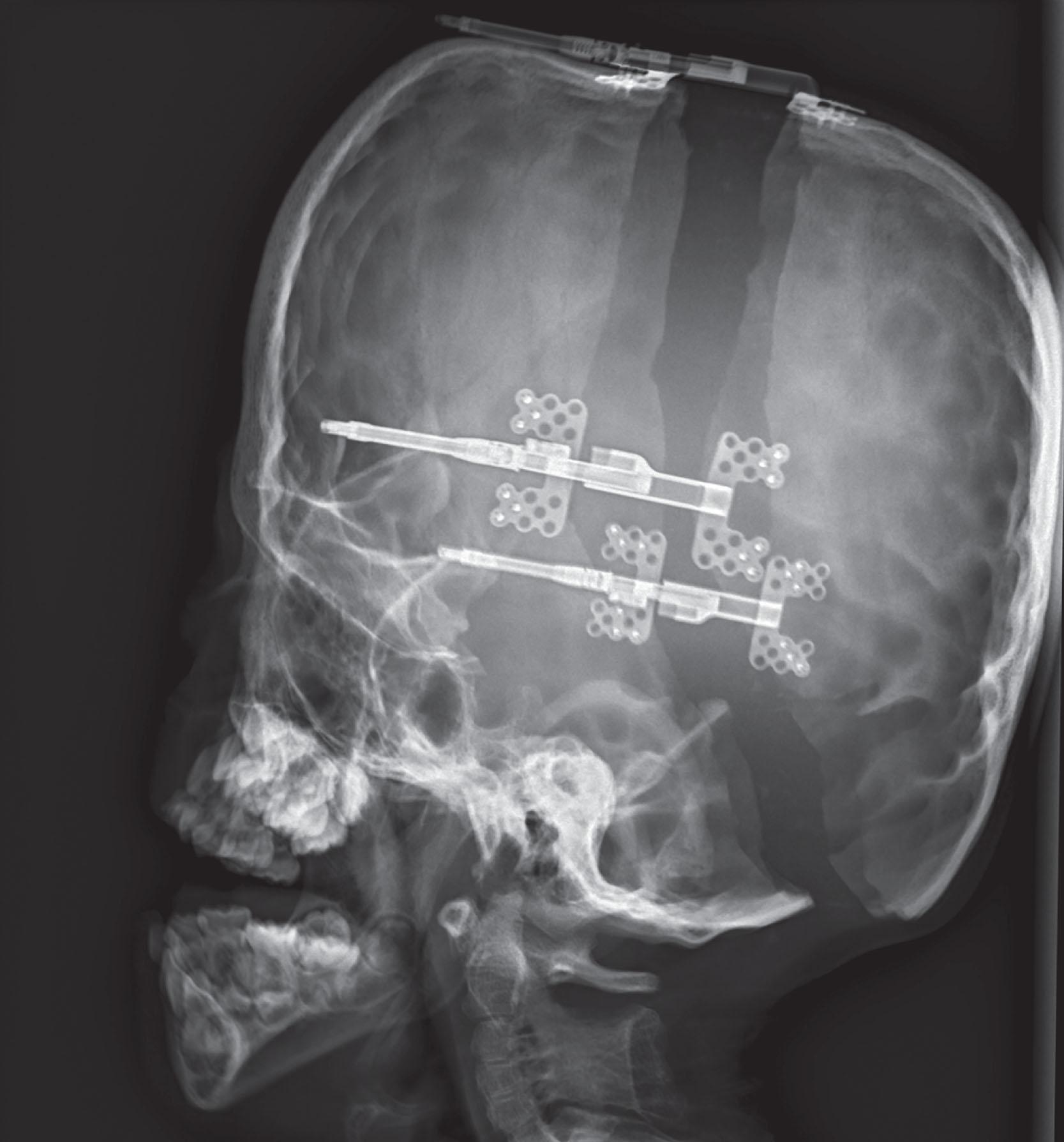 Figure 25.3.12, Lateral head radiograph of a patient with Apert syndrome at the end of the activation phase of posterior cranial vault distraction expansion. The posterior osteotomy has been placed as low as possible, with the superior osteotomy at the vertex. The vector is parallel to Frankfort horizontal to maximize volume per millimeter of activation. Two parallel distraction devices were initially placed just above the squamosal sutures, but when they were activated intraoperatively there was less expansion at the vertex. A third parallel device was therefore placed just off the midline of the vertex to achieve equal expansion of the entire osteotomy.