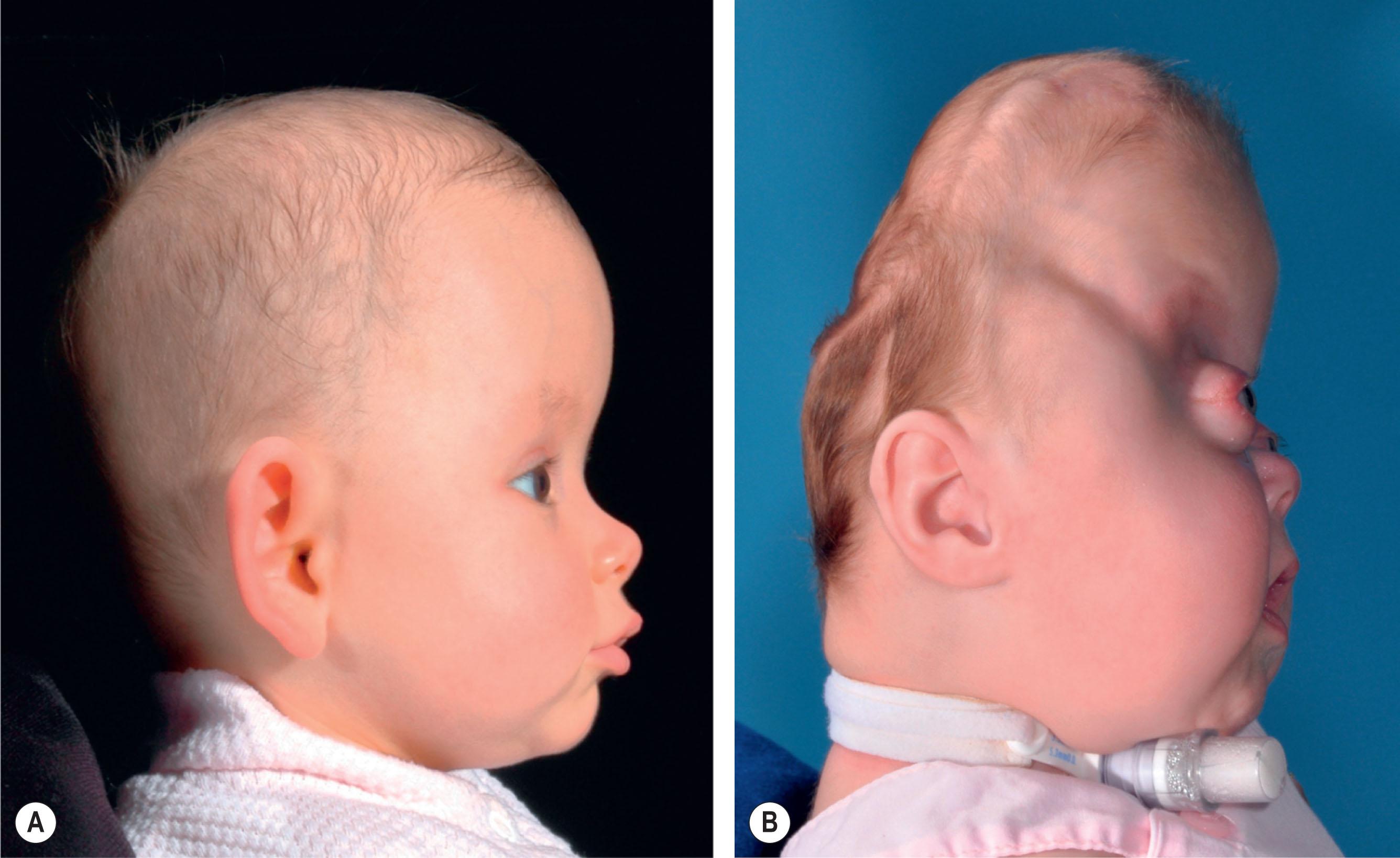 Figure 25.3.2, Clinical presentation of syndromic synostosis can vary from isolated bilateral coronal synostosis seen in Muenke craniosynostosis (A) to the pan-synostosis with severe cephalocranial disproportion seen in association with Pfeiffer syndrome (B) . The broad spectrum requires a surgical approach tailored to each case as described in Fig. 25.3.21 .