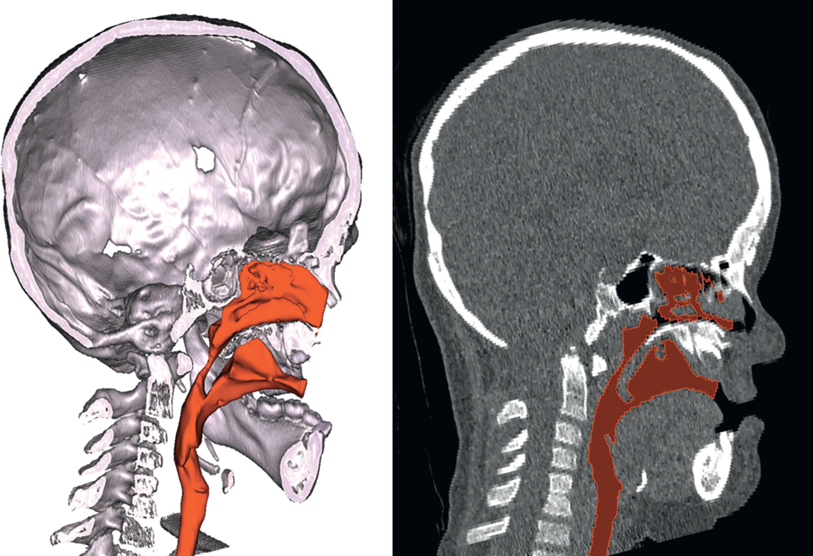 Figure 25.3.3, CT scan with colorized airway cast of a patient with Apert syndrome prior to midface advancement. The primary level of obstruction was at the nasopharyngeal junction and was treated with a LF2ZR distraction. Although the midface hypoplasia was the most severe deformity, many Apert and Pfeiffer patients also have unrecognized mandibular hypoplasia that restricts the airway at the base of the tongue. With the ability to fully correct midface deficiency with techniques such as distraction osteogenesis, most patients undergo traditional double jaw surgery at maturity that includes a large mandible advancement.