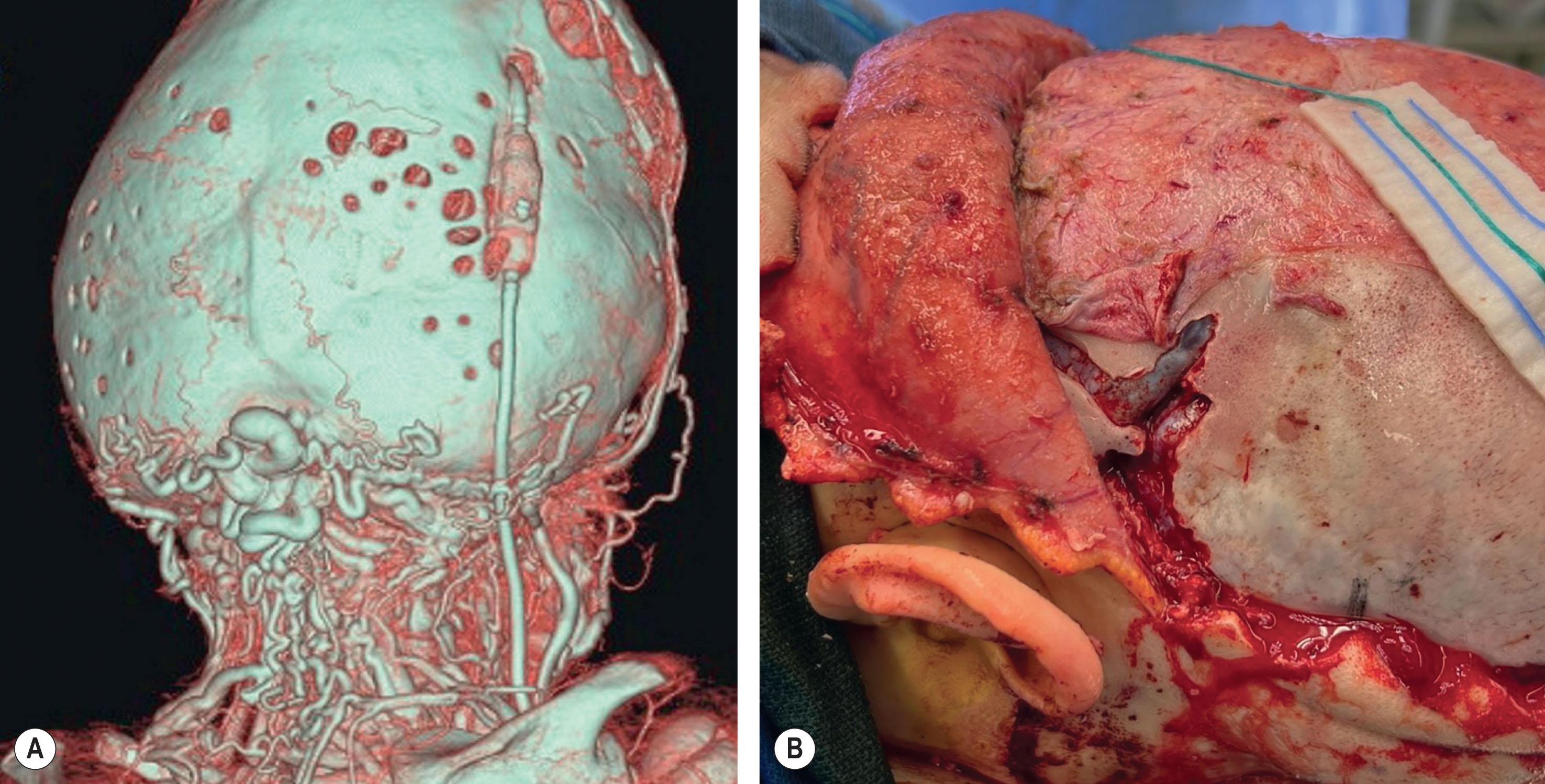 Figure 25.3.4, Patients with severe presentation of syndromic synostosis such as in Apert and Pfeiffer syndromes can have enlarged venous drainage to compensate for cephalocranial disproportion. (A) Enlarged compensatory transcranial drainage visualized on CT angiogram in a patient with Pfeiffer syndrome. Care should be taken to preserve these vessels whenever possible during cranial surgery since they provide compensatory drainage for the brain. (B) An engorged right transverse sinus that had been encased in endocranial bone required careful dissection during the osteotomy for posterior cranial vault distraction.