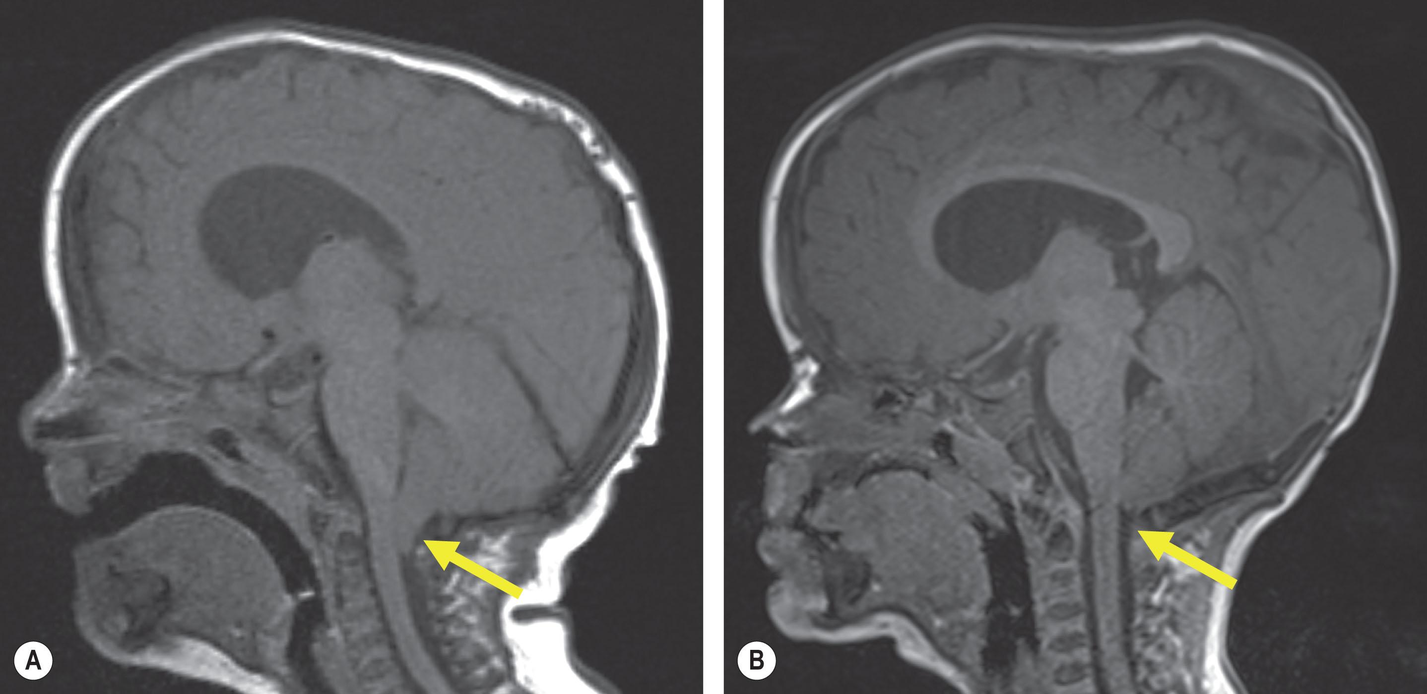 Figure 25.3.6, MRI scan of a patient with Crouzon syndrome and a Chiari malformation (arrow) before at age 5 months (A) and after at age 9 months (B) posterior cranial vault expansion. Note the resolution of the Chiari malformation after the increased posterior vault volume.