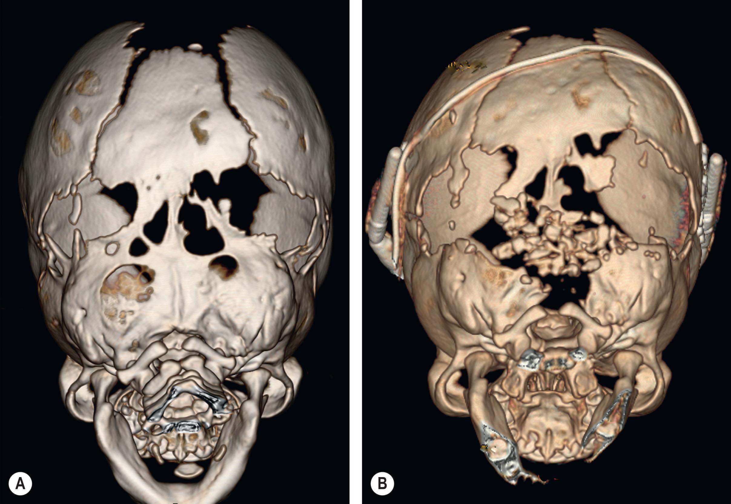 Figure 25.3.7, Posterior skull view of a 5-month-old patient with Apert syndrome before (A) and after (B) osteotomy for posterior vault distraction osteogenesis and placement of subperiosteal univector distraction devices. A simultaneous decompression of the posterior foramen magnum and skull base was performed due to radiographic evidence of bone compression in this region.