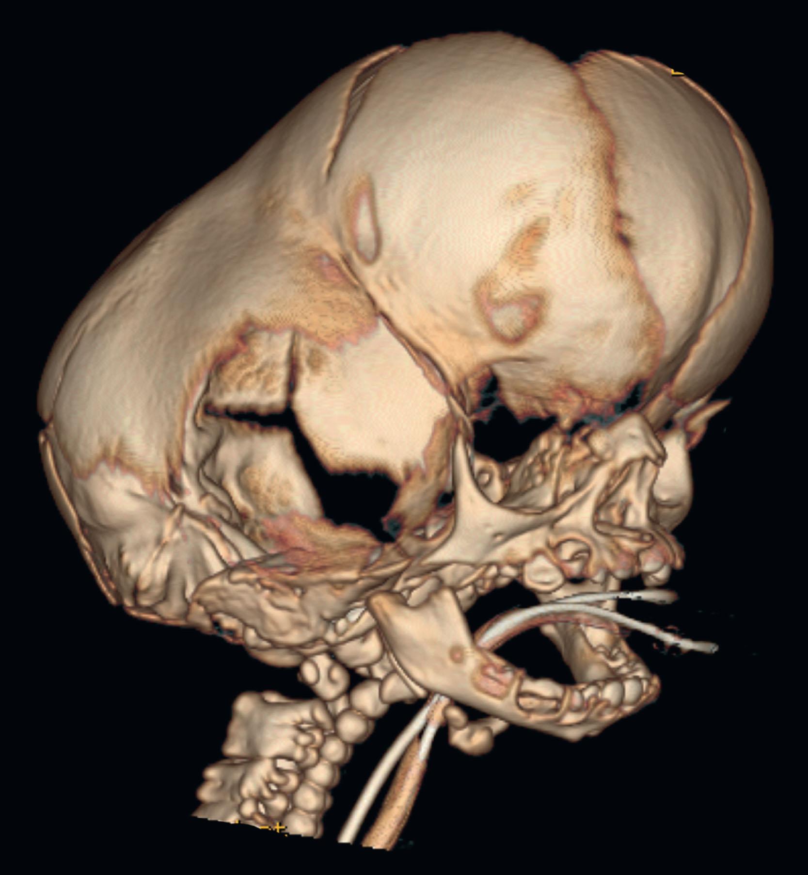 Figure 25.3.8, Newborn with a severe Pfeiffer phenotype with early cephalocranial disproportion. If left untreated it will result in progressive loss of calvarial bone through compensatory over expansion of patent minor sutures, such as the squamosal and fronto-zygomatic, as well as pressure erosion and thinning of the neonatal bone from the growing brain. Note the compensating large open anterior fontanelle and expanded squamosal sutures with temporal thinning in contrast to the thickened unyielding band of bone extending from the pterion and encircling the occiput.