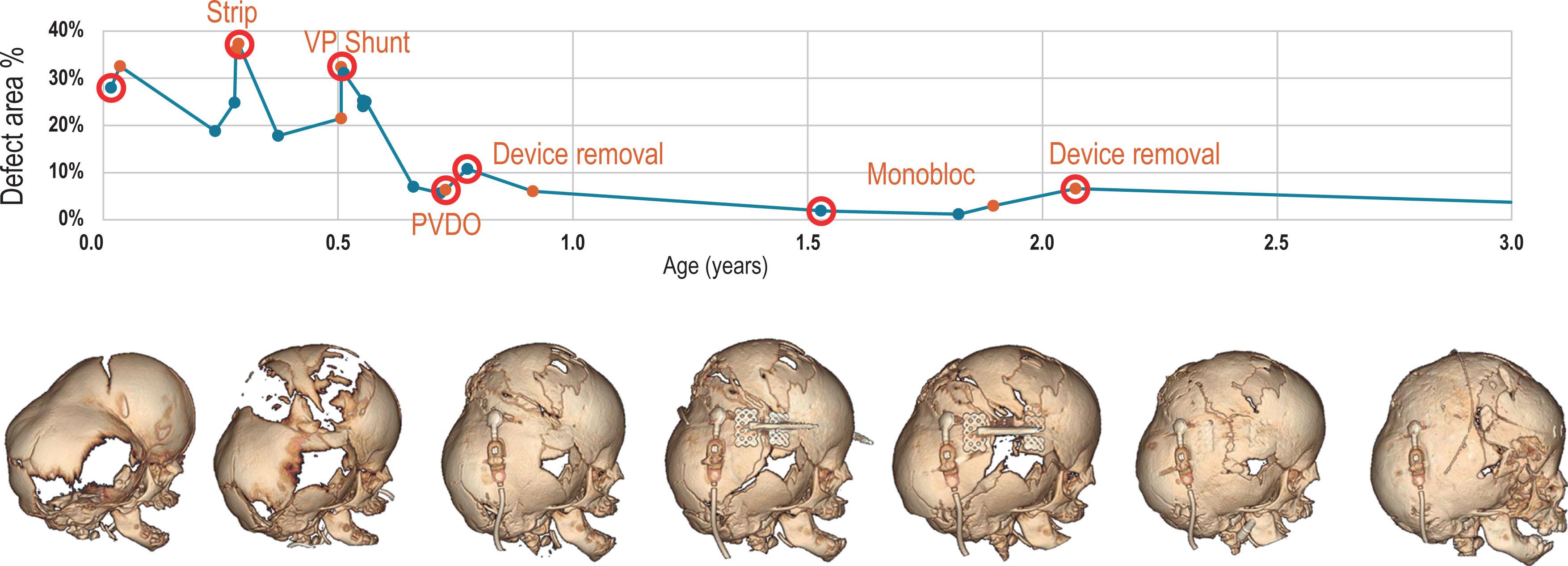 Figure 25.3.9, Treatment progression of patient shown in Fig. 25.3.8 illustrating the concept of “surfing the bone pressure wave”. Each staged treatment in the first year of life resets cephalocranial proportion, often by increasing cranial defect area, which then allows normal dural osteogenesis and a subsequent decrease in defect area over time. This particular progression follows sequence no. 5 in the waterfall staged treatment approach in Fig. 25.3.21 .