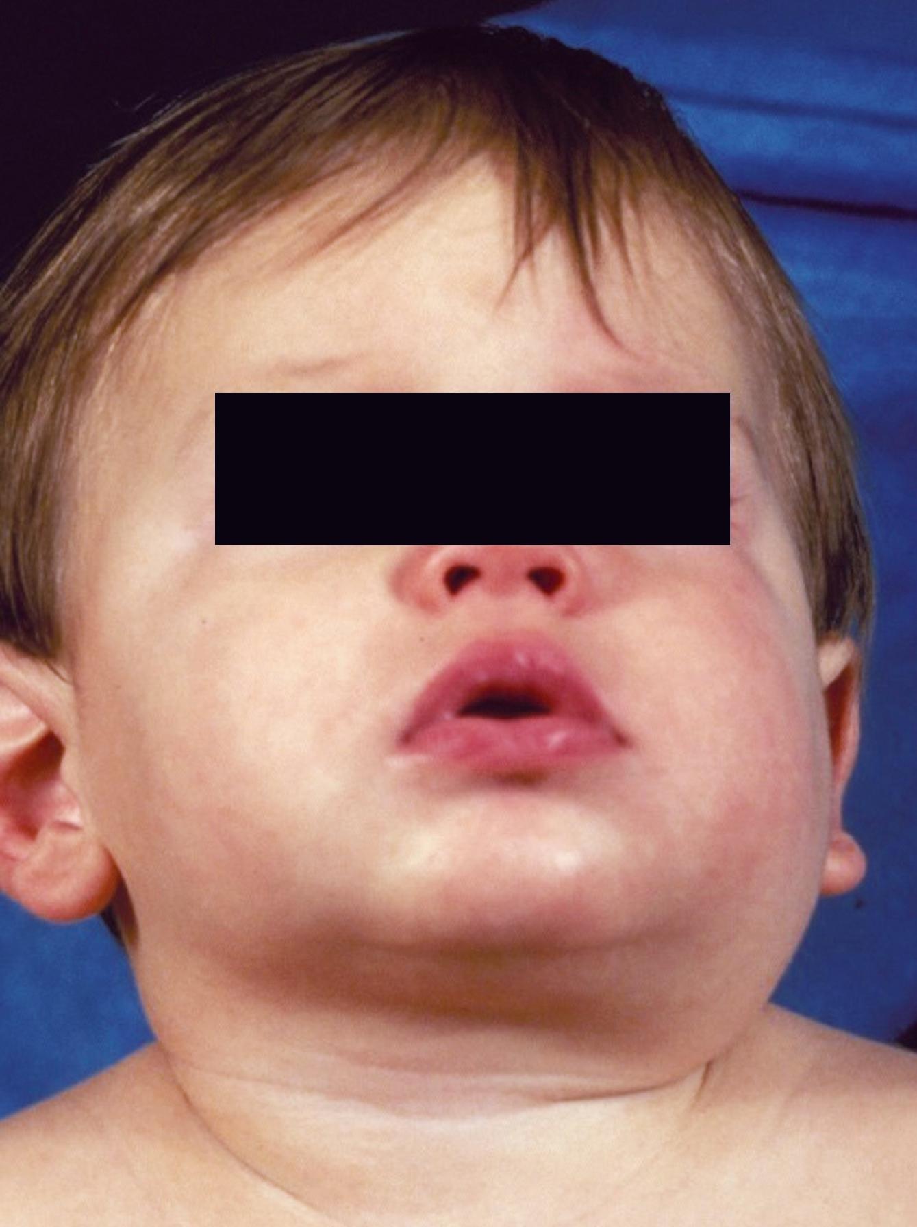 FIGURE 224.3, Toddler with mumps parotitis.