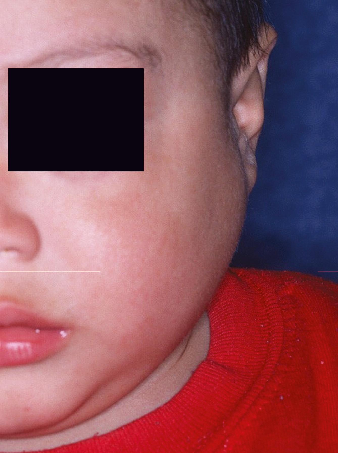 FIGURE 224.4, Boy with parotitis not due to mumps virus.