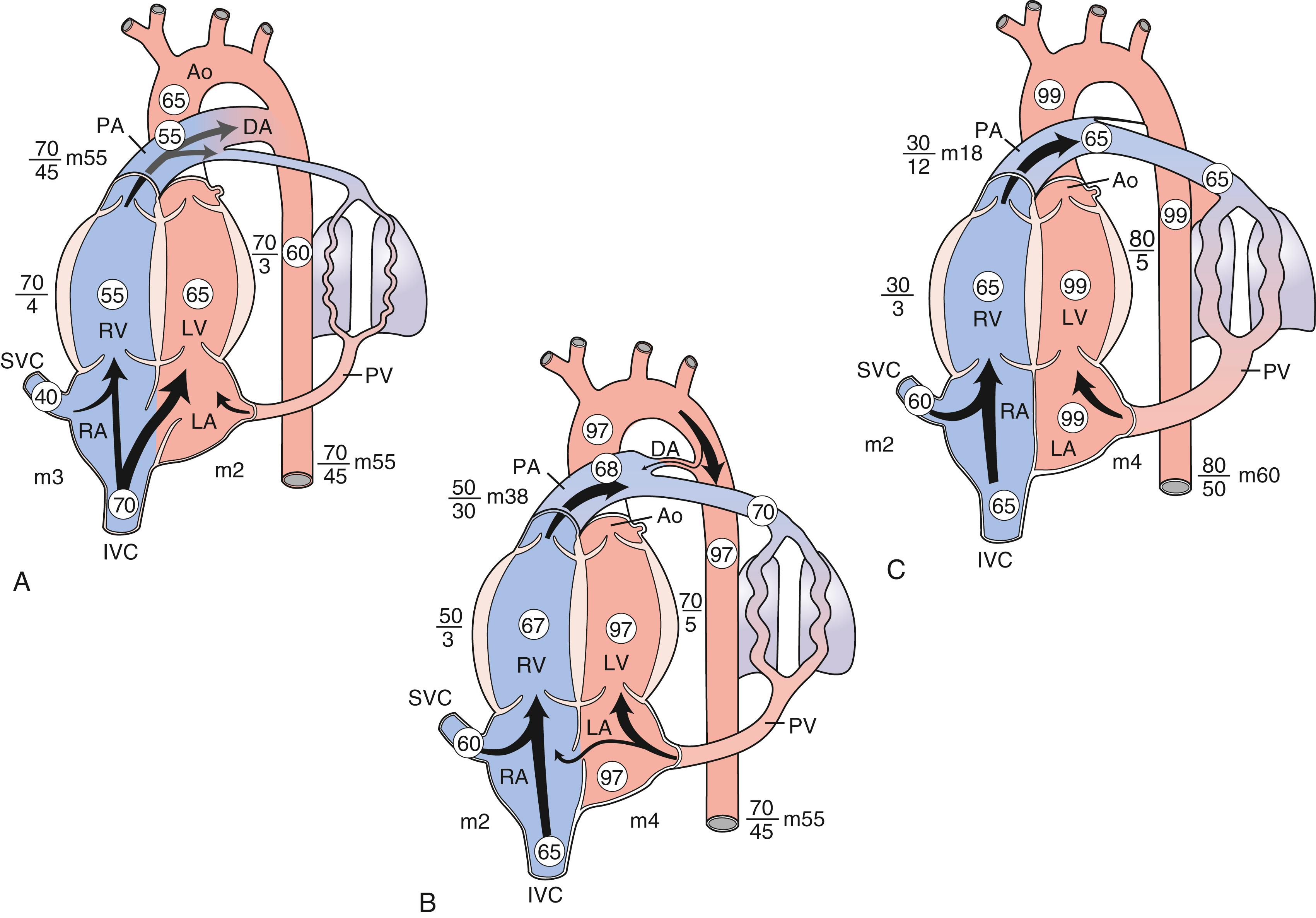 Fig. 9.3, Fetal (A) , transitional (B) , and neonatal (C) circulations. The course of the circulation in the heart and great arteries of the late-gestation fetal lamb, within a few hours of delivery and as a newborn, are presented. The figures in the circles within the chambers and vessels represent percent oxygen saturation. The numbers alongside the chambers and vessels are pressures in mm Hg related to amniotic fluid pressure as zero. Ao, aorta; DA, ductus arteriosus; IVC, inferior vena cava; LA, left atrium; LV, left ventricle; m, mean; PA, pulmonary artery; PV, pulmonary vein; RA, right atrium; RV, right ventricle; SVC, superior vena cava.