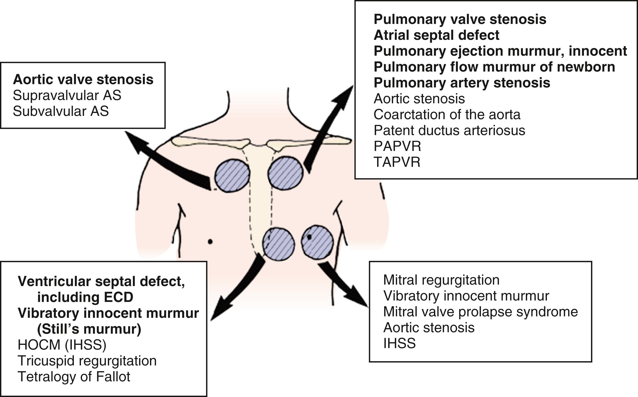 Fig. 9.5, Diagram showing the locations at which certain systolic murmurs are most readily auscultated. Less common conditions are shown in smaller type. AS, aortic stenosis; ECD, endocardial cushion defect; HOCM, hypertrophic obstructive cardiomyopathy; IHSS, idiopathic hypertrophic subaortic stenosis; PAPVR, partial anomalous pulmonary venous return; TAPVR, total anomalous pulmonary venous return.