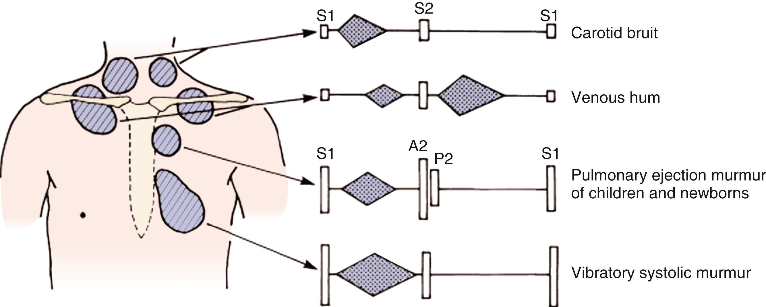 Fig. 9.6, Diagram of innocent heart murmurs in children.