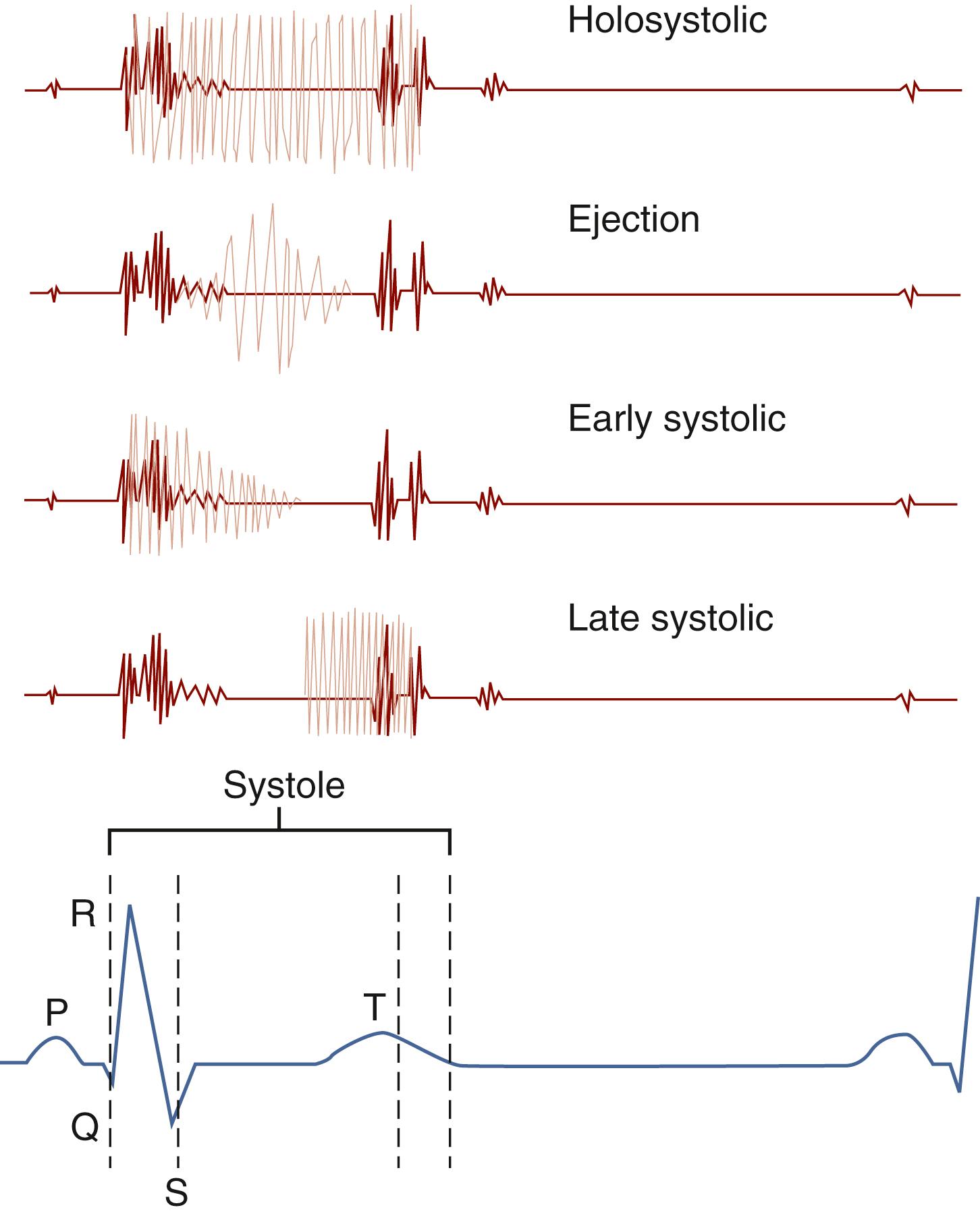 Fig. 9.7, Four classes of systolic heart murmurs. The holosystolic or pansystolic murmur begins abruptly with the first heart sound (S 1 ) and proceeds at the same intensity to the second heart sound (S 2 ). The ejection systolic or crescendo-decrescendo murmur begins with the onset of volume ejection from the heart. As the flow increases, the murmur varies both in intensity and frequency and subsequently tapers as the period of ejection ceases, before the S 2 . The early systolic murmur begins, as does the holosystolic murmur, abruptly with S 1 but terminates in mid-systole with the cessation of shunt flow. The late systolic murmur begins well after S 1 , commencing in mid- to late systole in association with the development of valve insufficiency, and proceeds at this intensity to S 2 .