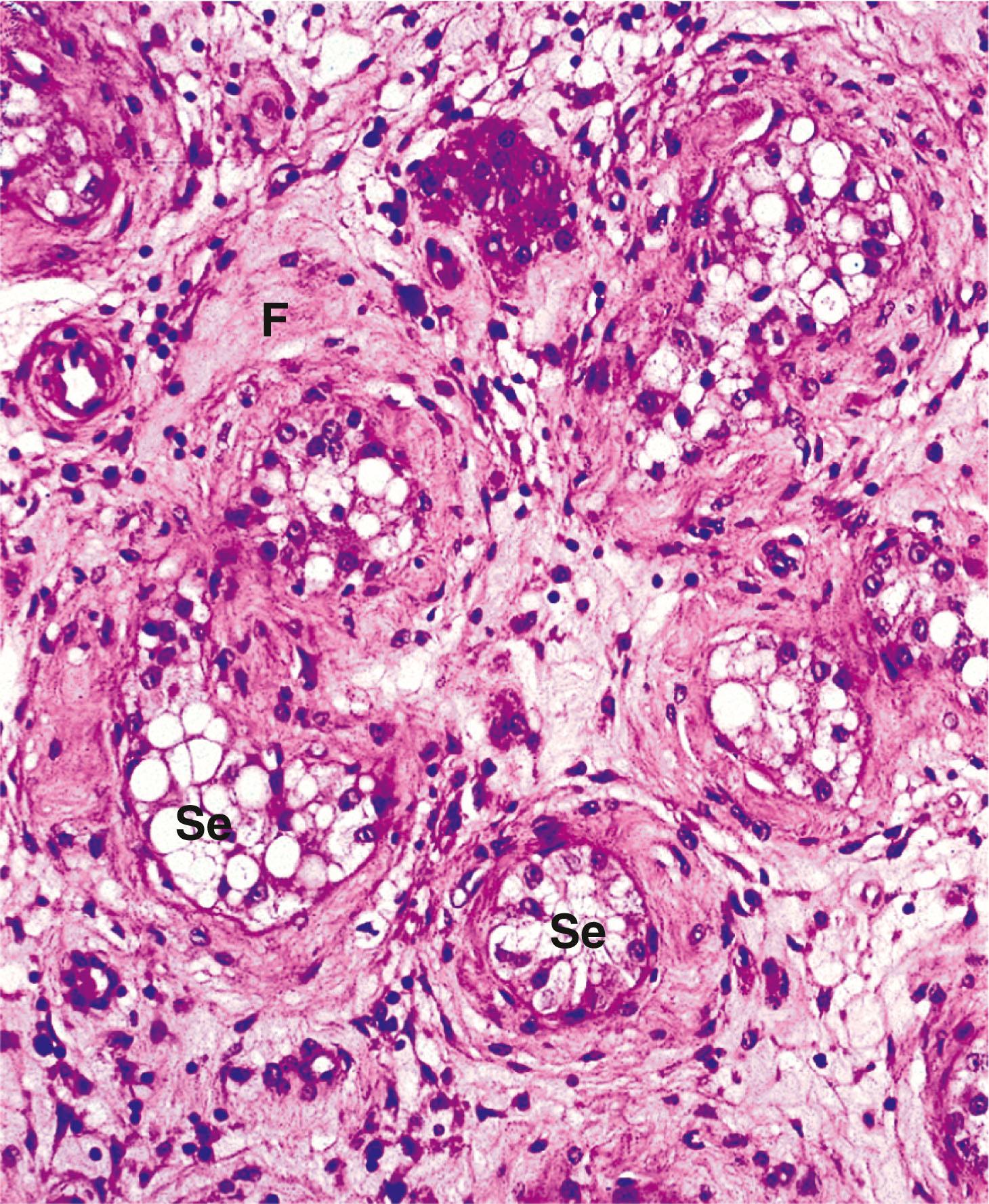 E-Fig. 6.1, Atrophic testis (HP)