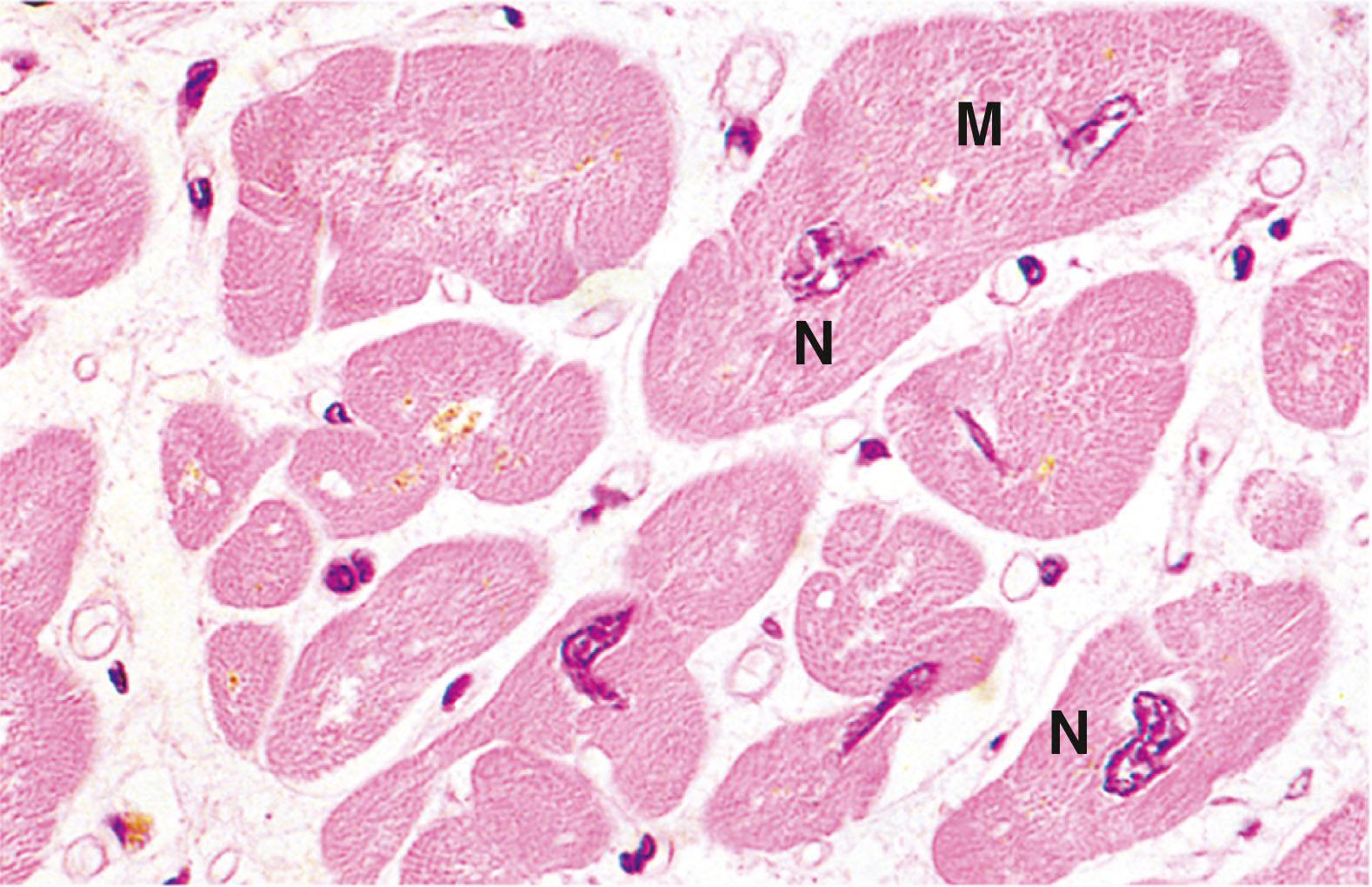 E-Fig. 6.2, Hypertrophic myocardium (MP)