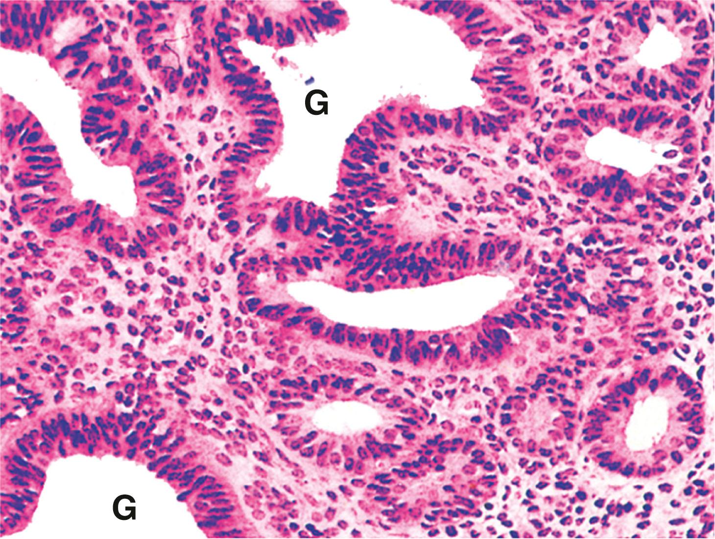 E-Fig. 6.3, Hyperplasia of endometrium (HP)