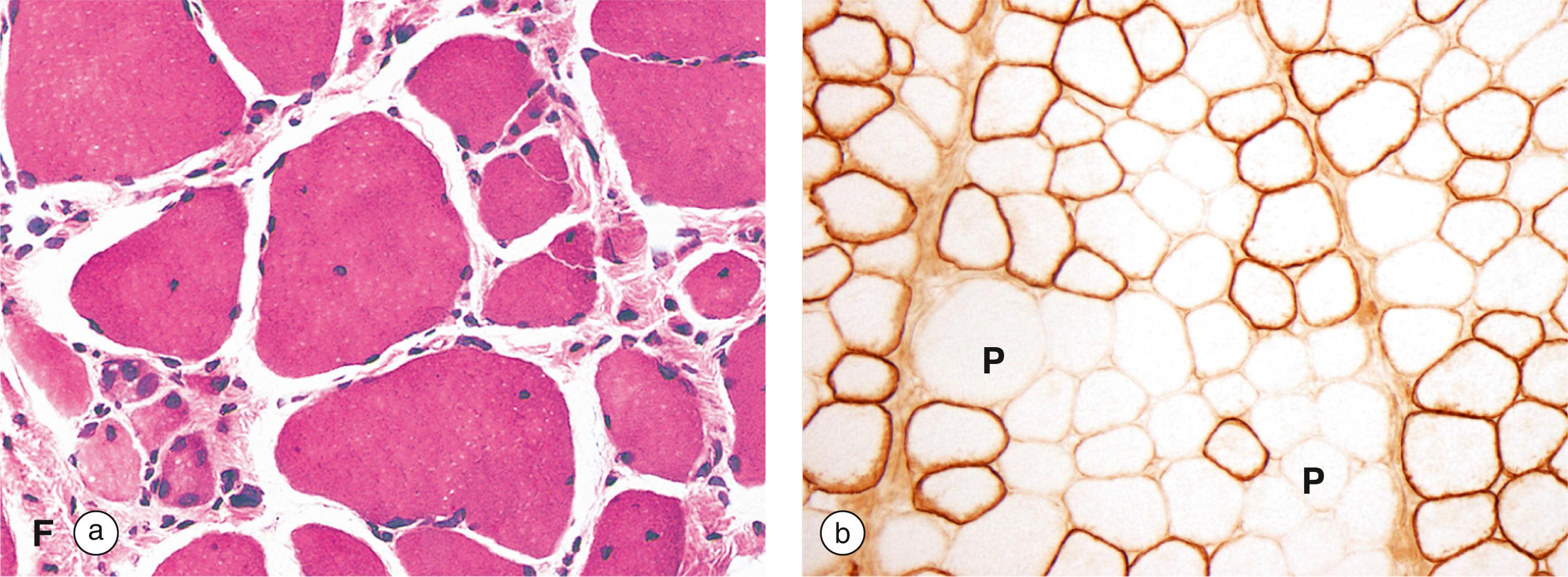 E-Fig. 6.4, Muscular dystrophy