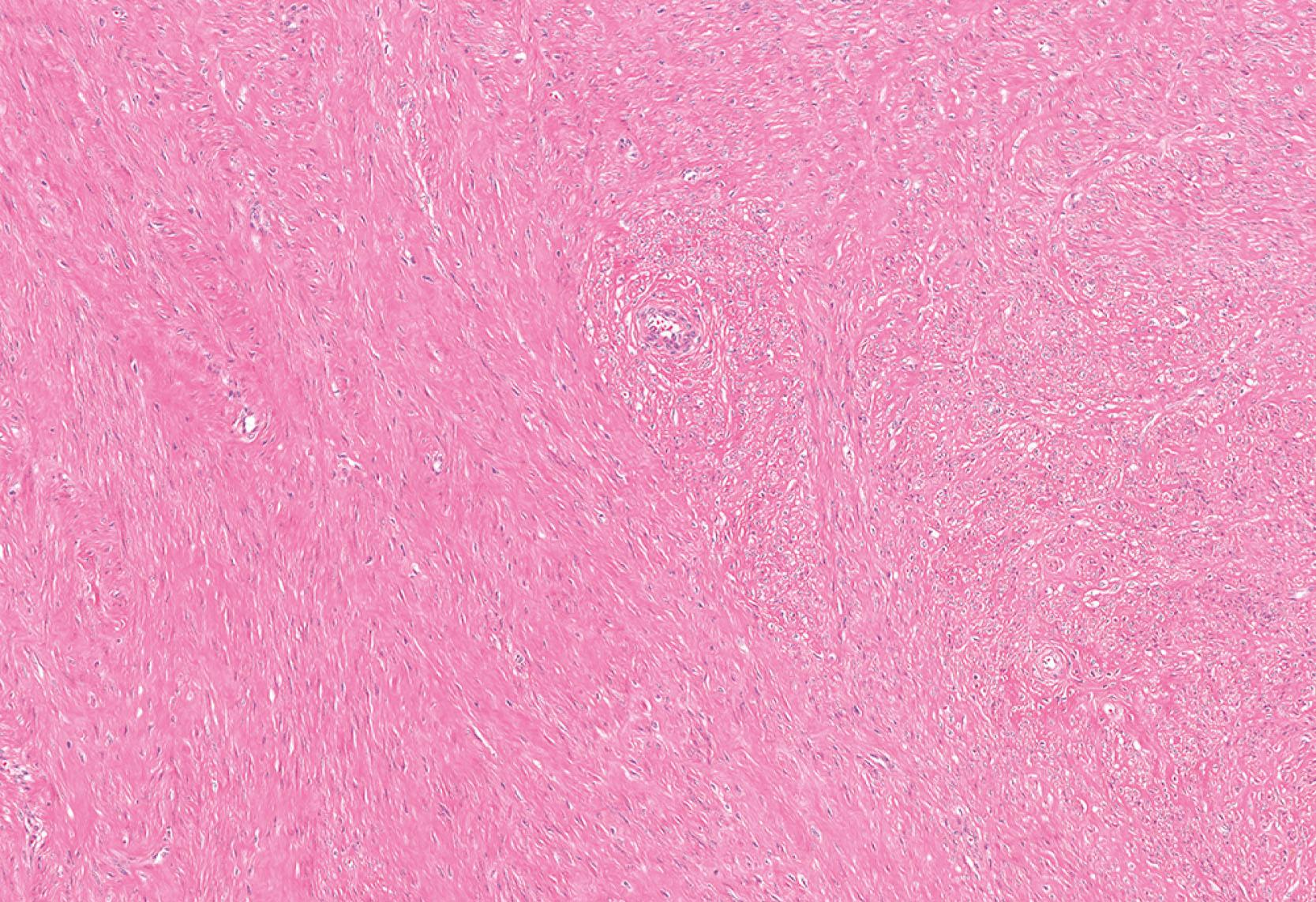 E-Fig. 6.5, Leiomyoma