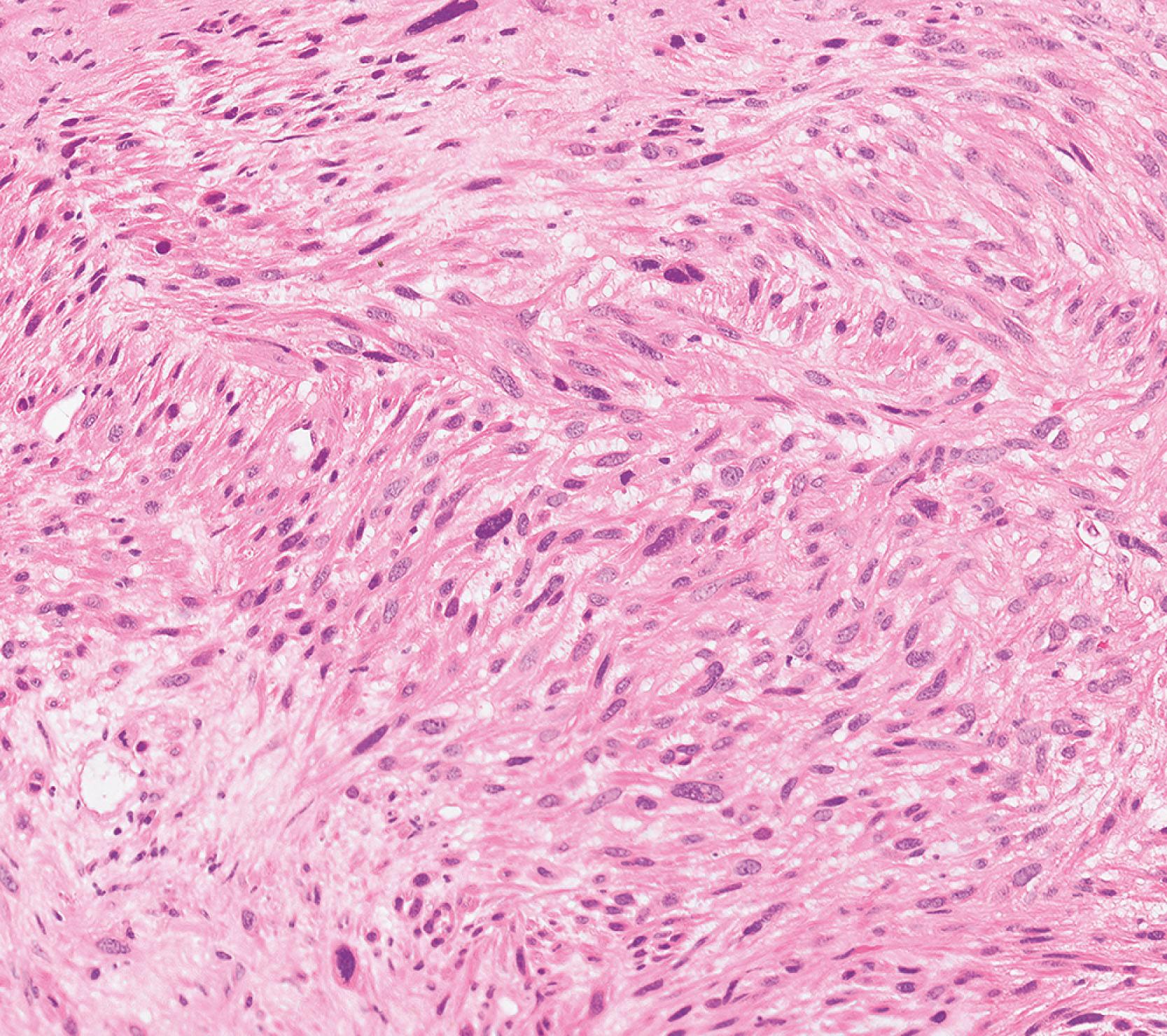 E-Fig. 6.6, Leiomyosarcoma