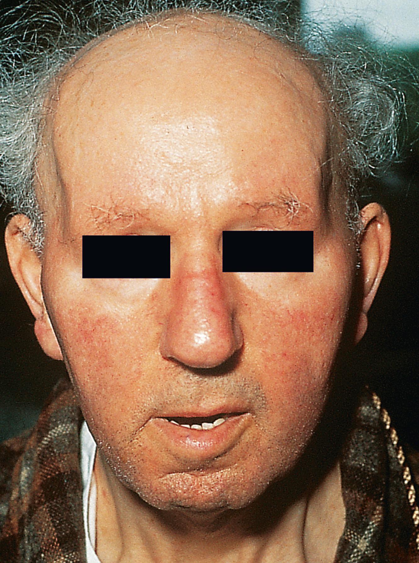 FIGURE 389-2, Myotonic dystrophy in a 50-year-old man.