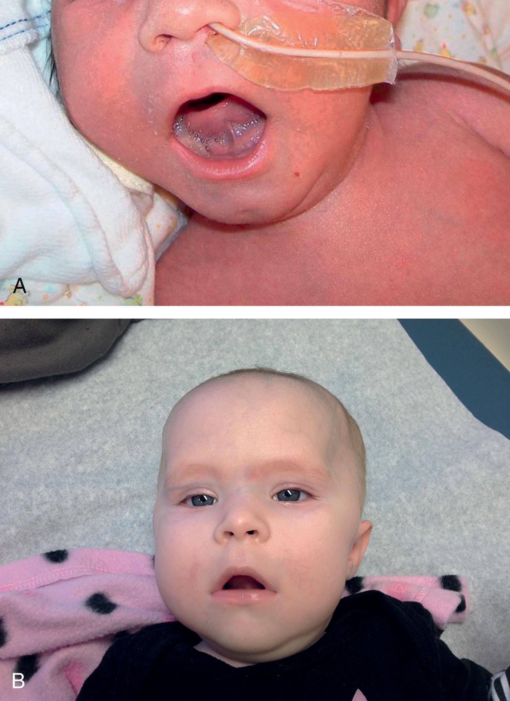 Fig. 37.1, Congenital myotonic dystrophy: facial appearance in the neonatal and infantile period . (A) Note the facial diplegia with tent-shaped appearance of upper lip in this newborn. (B) Same affected infant at an older age; note the facial diplegia, tented upper lip, and temporalis muscle atrophy.